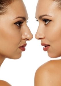 Mujeres enfrentando la cara luego de una Rinoplastia. DuqueMD