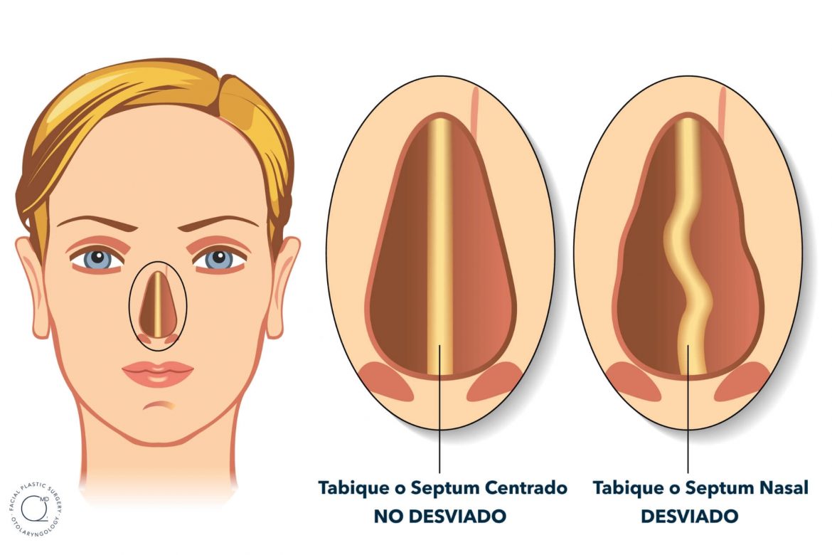Ilustración Tabique Desviado y no desviado. Septorrinoplastia DuqueMD Dr. Jorge Duque Silva