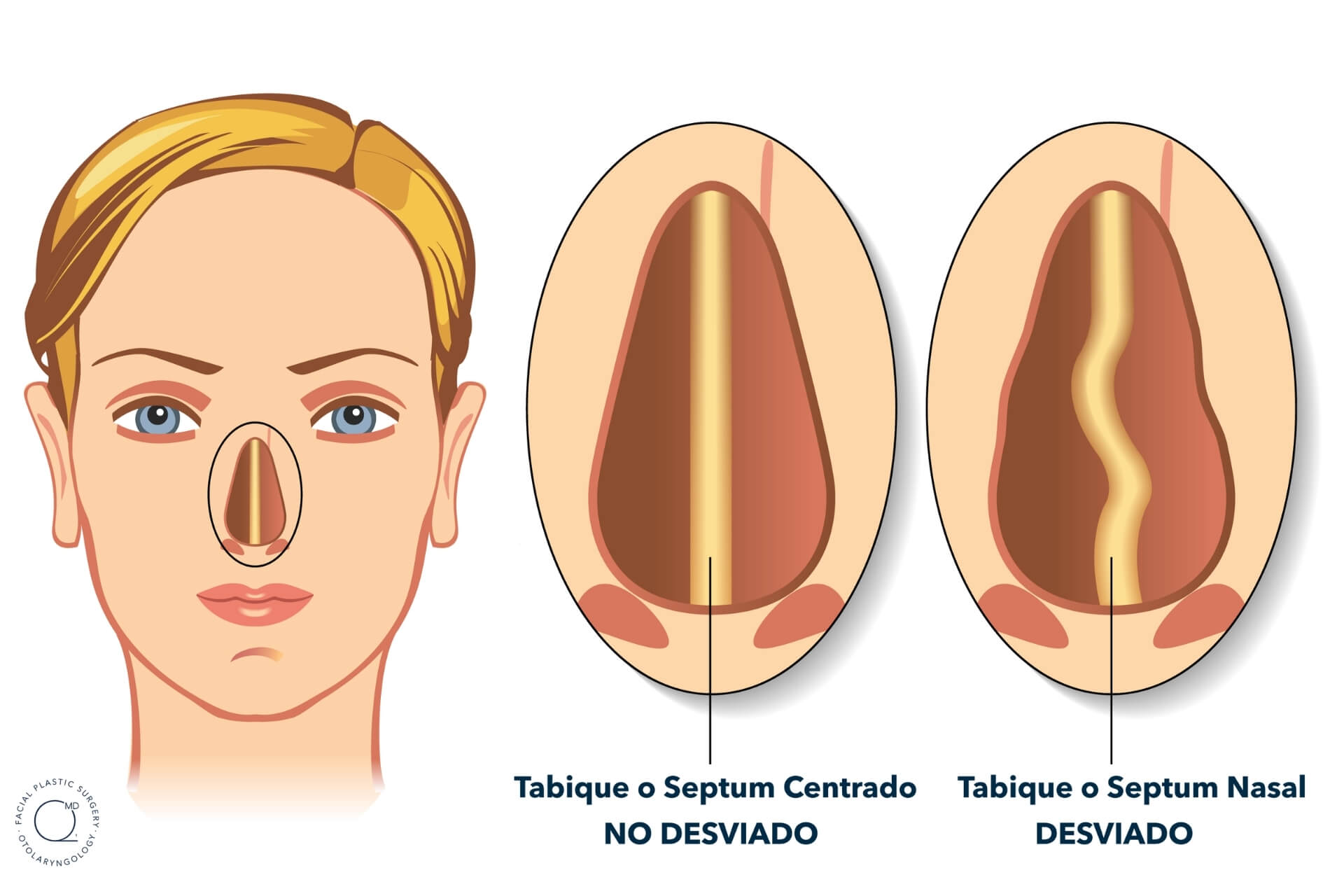 CORRECTORES NASALES Te Ayudan A Cambiar La Forma De Tu Nariz