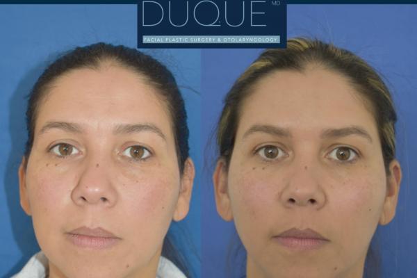 Rejuvenecimiento Facial Caso 2 DuqueMD